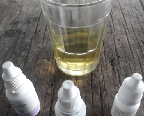 Clearing Conjunctivitis With Your Own Urine!
